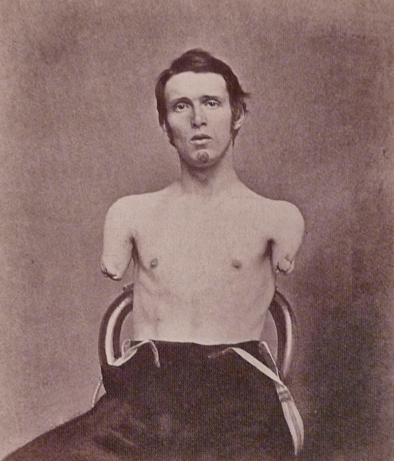 Amputations in the Civil War | Alamy Stock Photo by Niday Picture Library